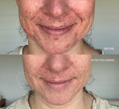 Clearly Blemish Mask